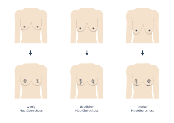 Grafik Bruststraffung, Plastische und Ästhetische Chirurgie Reutlingen, Prof. Dr. med. Manuel Held