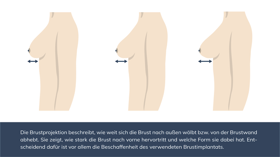 Grafik Projektionen Brustimplantat, Plastische und Ästhetische Chirurgie Reutlingen, Prof. Dr. med. Manuel Held