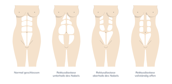 Grafik Rektusdiastase OP, Plastische und Ästhetische Chirurgie Reutlingen, Prof. Dr. med. Manuel Held