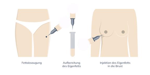 Grafik Brustvergrößerung Eigenfett, Plastische und Ästhetische Chirurgie Reutlingen, Prof. Dr. med. Manuel Held