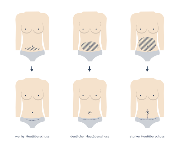 Grafik Bauchdeckenstraffung, Plastische und Ästhetische Chirurgie Reutlingen, Prof. Dr. med. Manuel Held