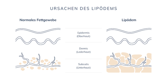 Grafik Ursachen Lipödem, Plastische und Ästhetische Chirurgie Reutlingen, Prof. Dr. med. Manuel Held