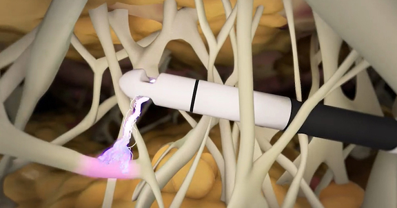 Renuvion, Plastische und Ästhetische Chirurgie Reutlingen, Prof. Dr. med. Manuel Held