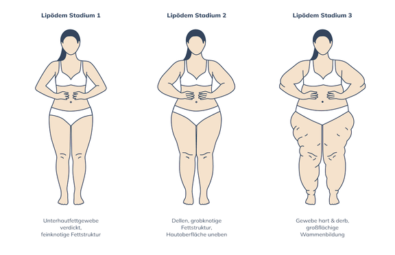 Grafik Stadien Lipödem, Plastische und Ästhetische Chirurgie Reutlingen, Prof. Dr. med. Manuel Held