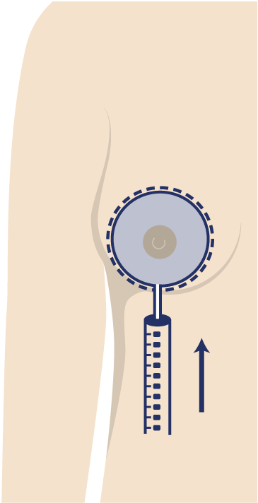 Grafik Motiva Preservé™, Plastische und Ästhetische Chirurgie Reutlingen, Prof. Dr. med. Manuel Held